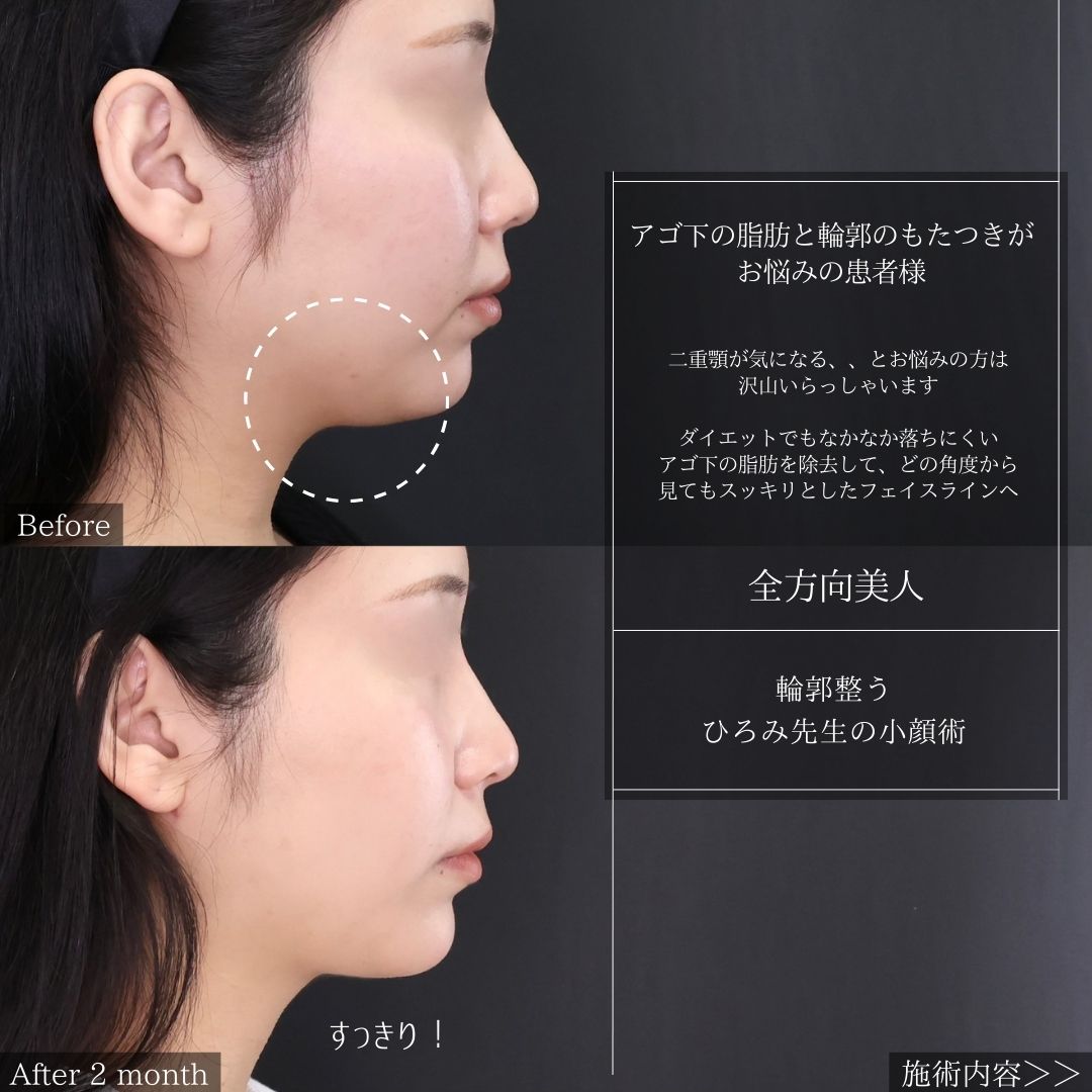 TAC式 ツヤ肌コラーゲンリフト®/顎下の脂肪吸引・顔の脂肪吸引/顎のヒアルロン酸注射の症例写真 施術前後 