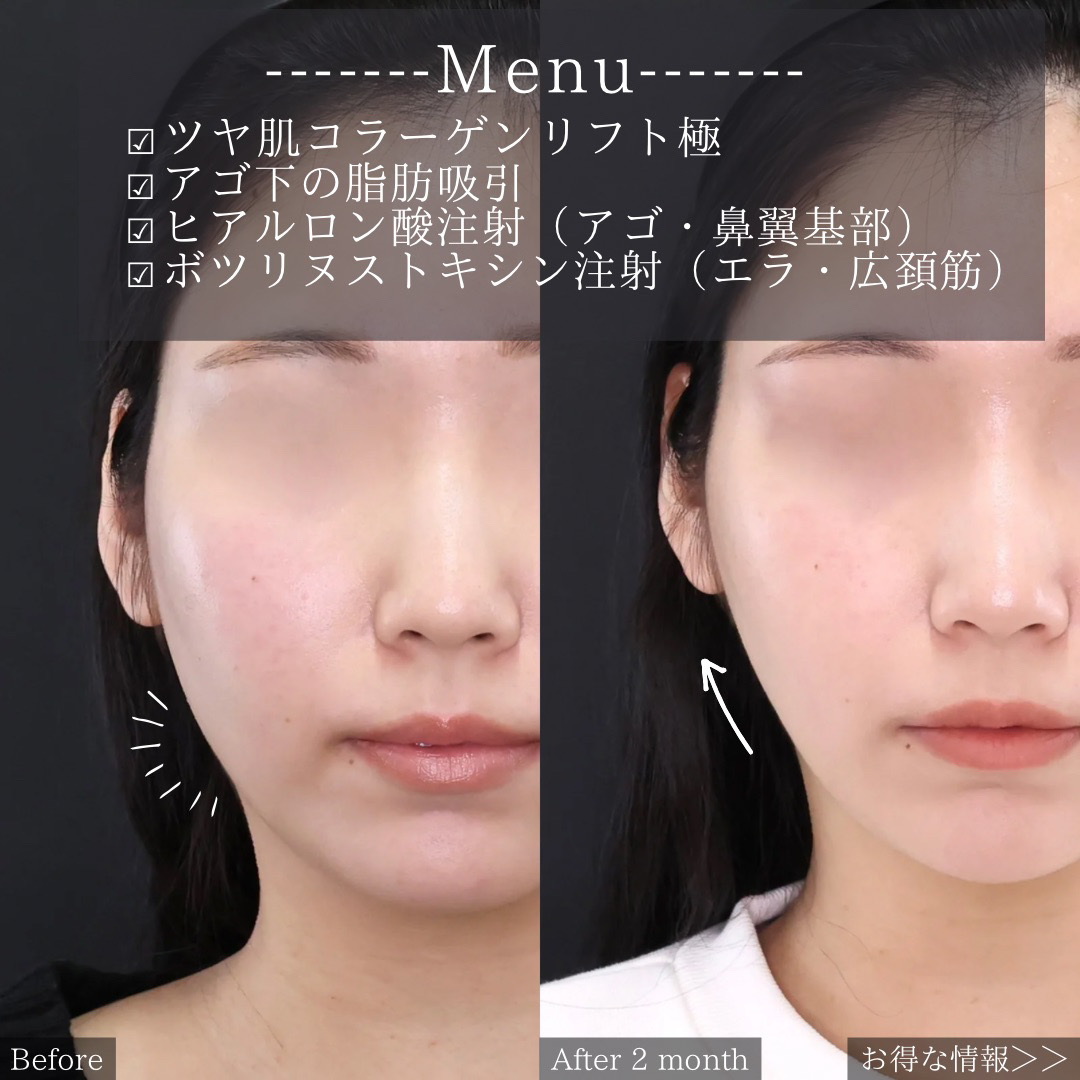 TAC式 ツヤ肌コラーゲンリフト®/顎下の脂肪吸引・顔の脂肪吸引/顎のヒアルロン酸注射の症例写真 施術前後 