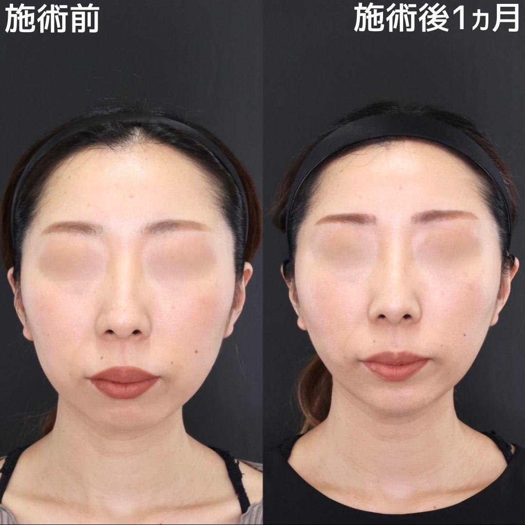 【糸リフト×脂肪除去】口元のもたつき0で若々しい印象に