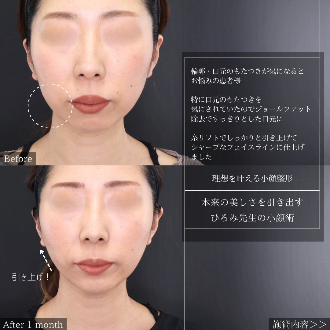 TAC式 ツヤ肌コラーゲンリフト®/ジョールファット除去/ボトックス注射：その他の症例写真 施術前後 