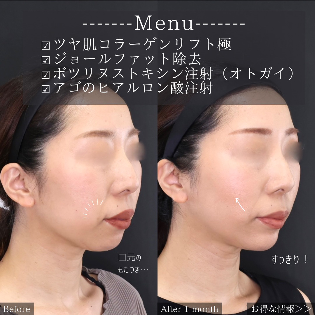 TAC式 ツヤ肌コラーゲンリフト®/ジョールファット除去/ボトックス注射：その他の症例写真 施術前後 