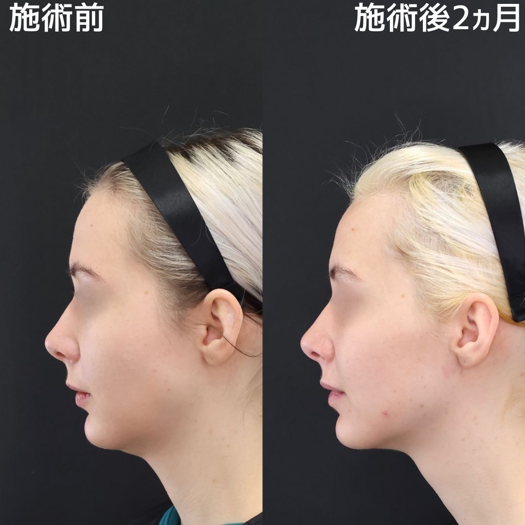 【糸リフト×アゴ下の脂肪吸引】輪郭整い、もたつき0に