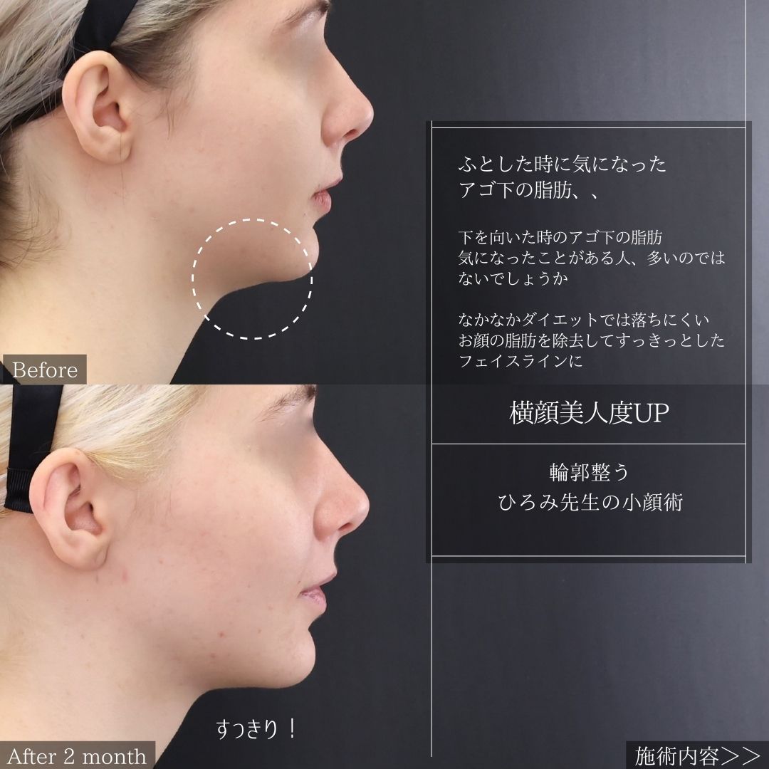 TAC式 ツヤ肌コラーゲンリフト®/顔の脂肪吸引の症例写真 施術前後 