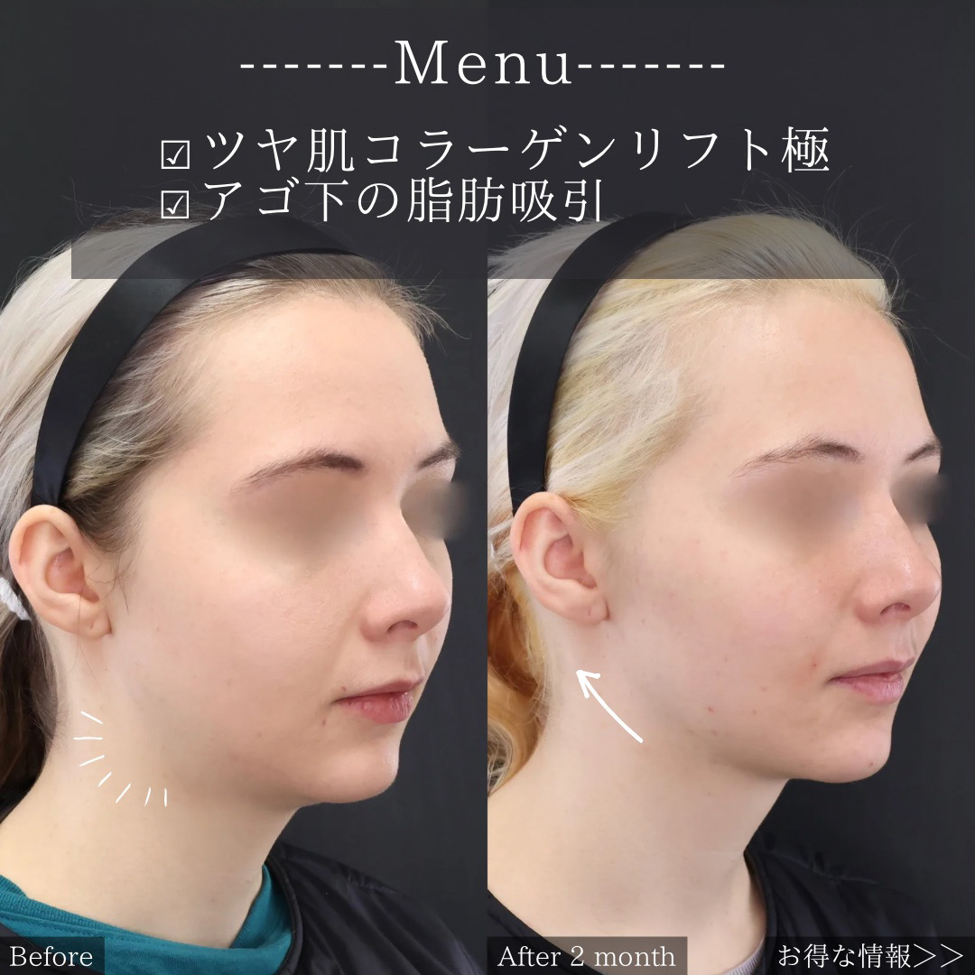 TAC式 ツヤ肌コラーゲンリフト®/顔の脂肪吸引の症例写真 施術前後 