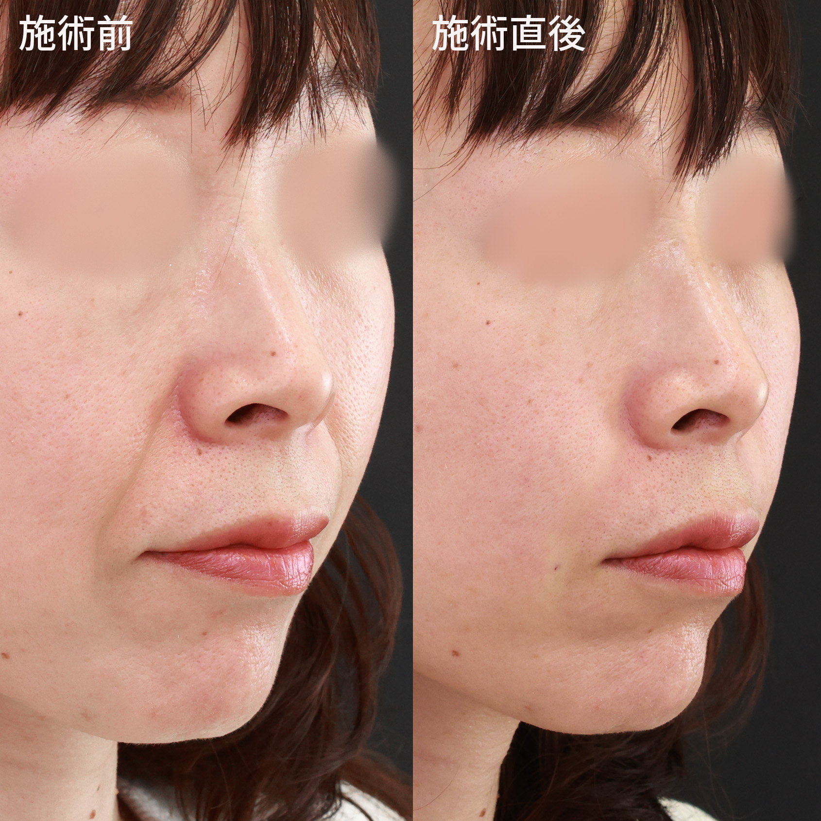 ほうれい線のヒアルロン酸注射の症例写真 施術前後 40代女性 施術直後 斜め