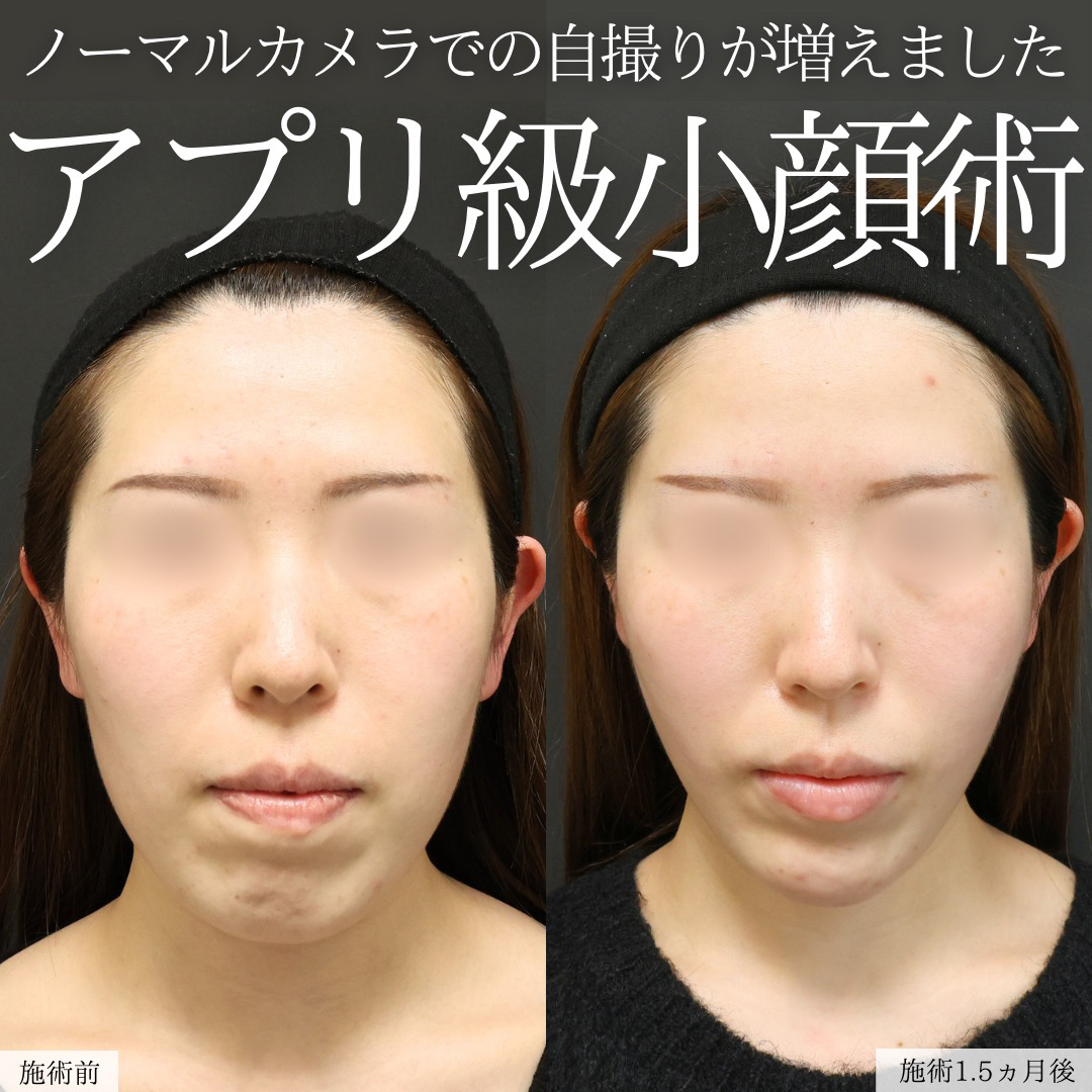TAC式 ツヤ肌コラーゲンリフト®/ジョールファット除去/顔の脂肪吸引の症例写真 施術前後