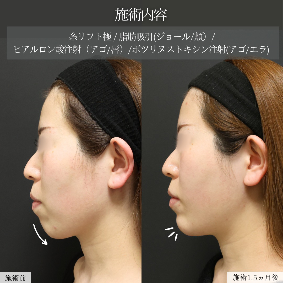 TAC式 ツヤ肌コラーゲンリフト®/ジョールファット除去/顔の脂肪吸引の症例写真 施術前後