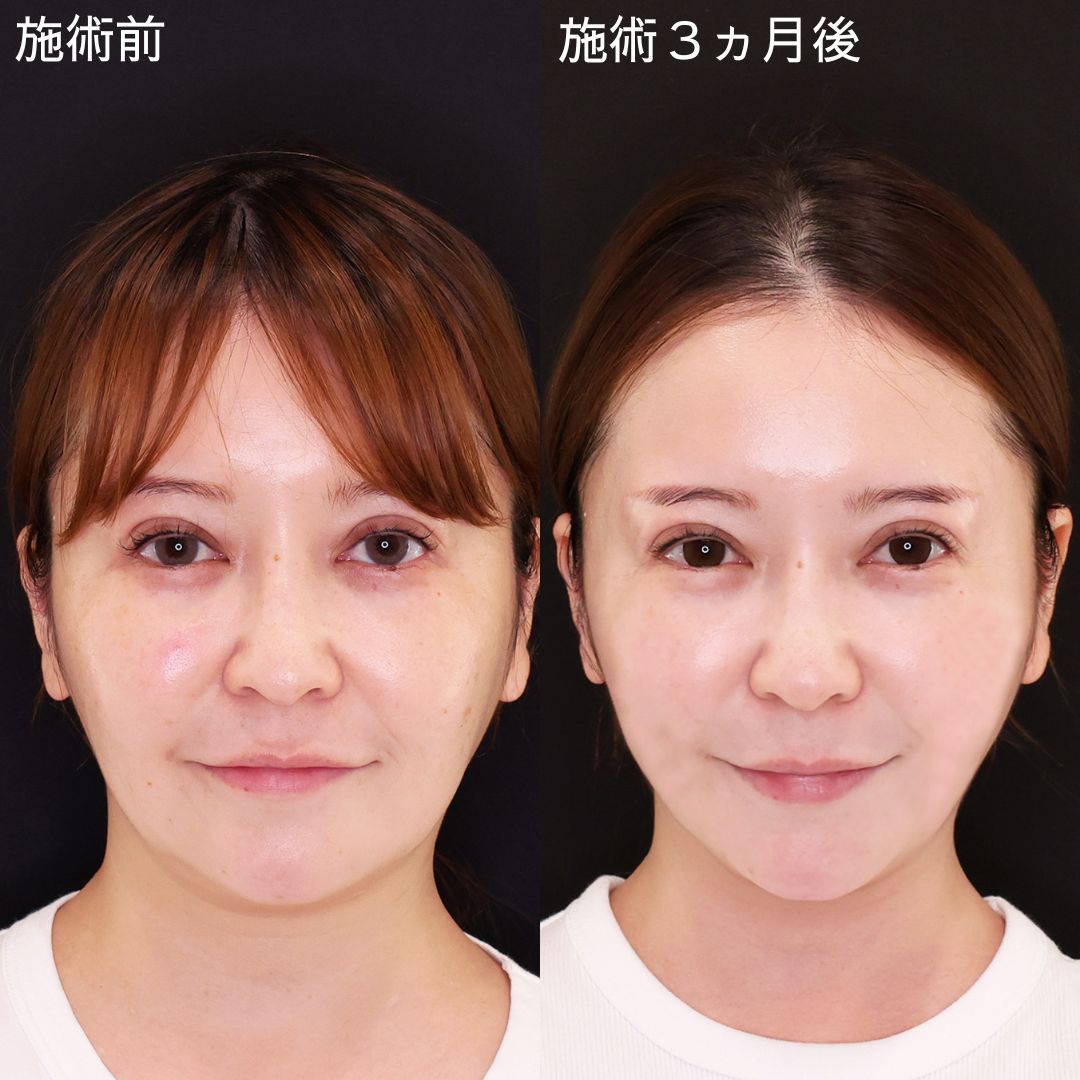 ナチュラルに輪郭を洗練！理想の美輪郭に導く小顔術【糸リフト×脂肪除去】