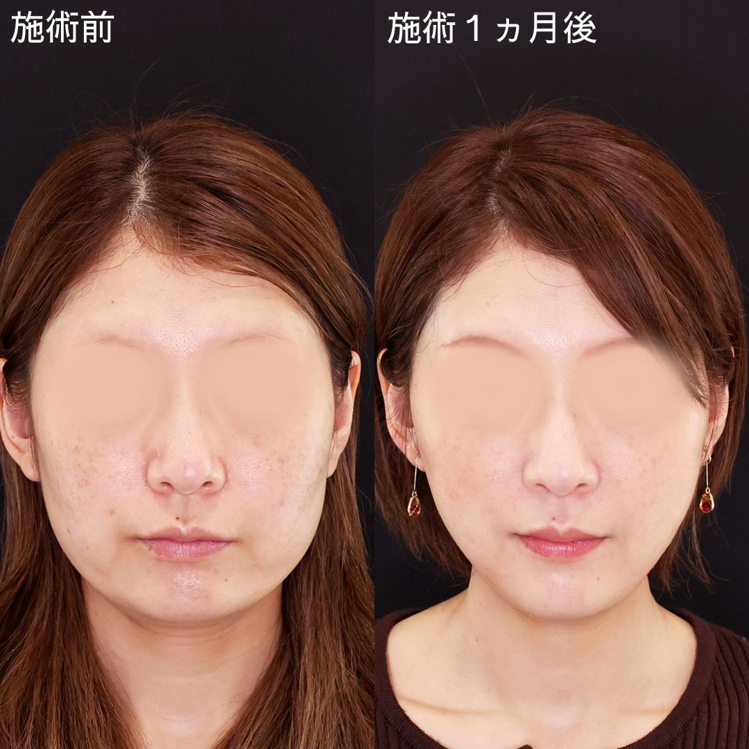 確実な変化をもたらすDr.石橋の別人級小顔術！【糸リフト×脂肪吸引】