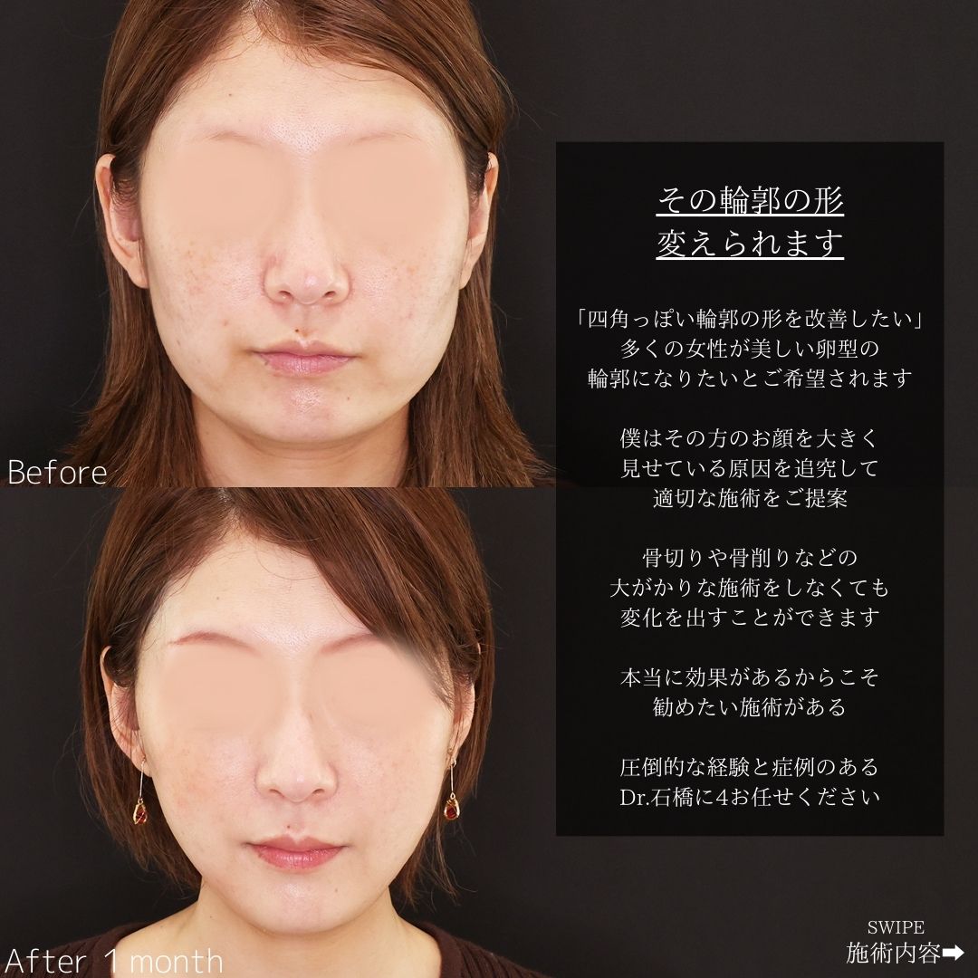 TAC式 ツヤ肌コラーゲンリフト®/ジョールファット除去/顔の脂肪吸引の症例写真 施術前後 