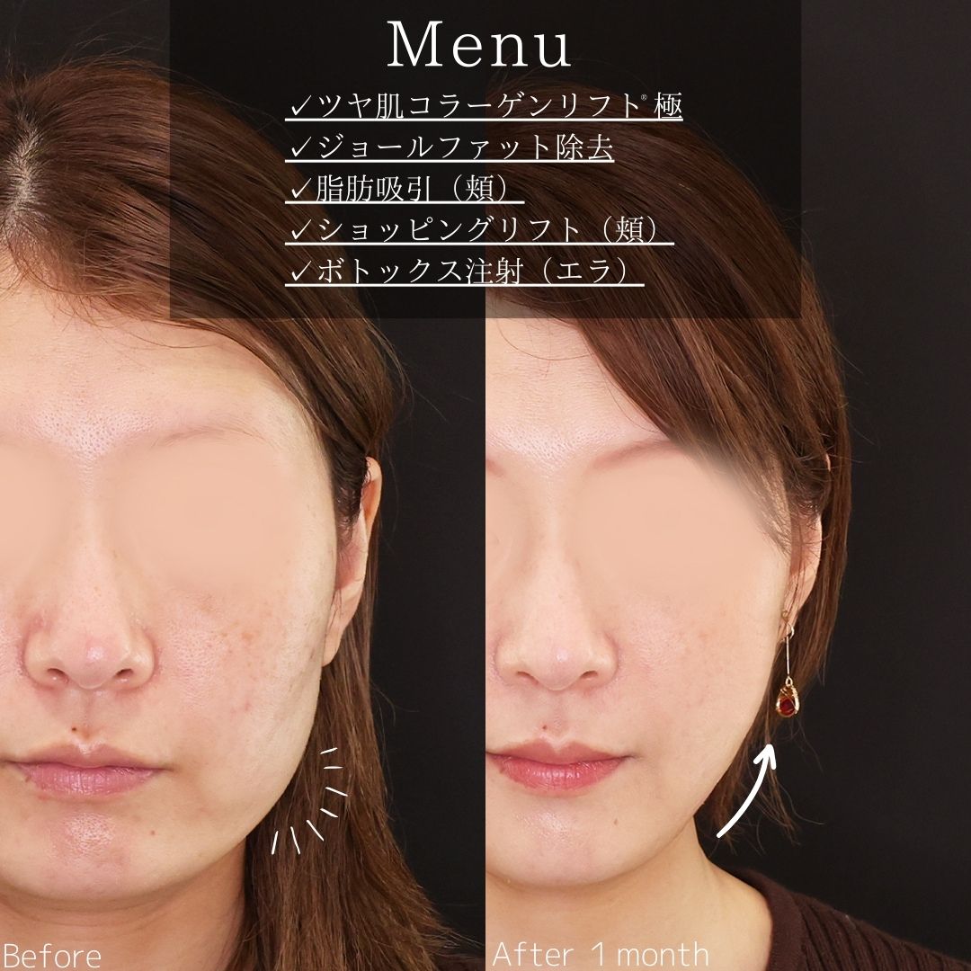 TAC式 ツヤ肌コラーゲンリフト®/ジョールファット除去/顔の脂肪吸引の症例写真 施術前後 