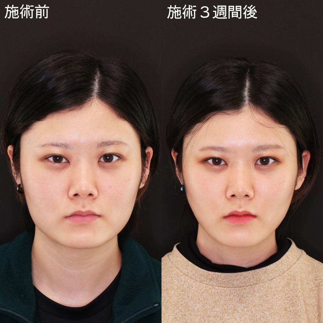 糸リフトのみで確実な変化を！Dr.石橋の小顔術【糸リフト】