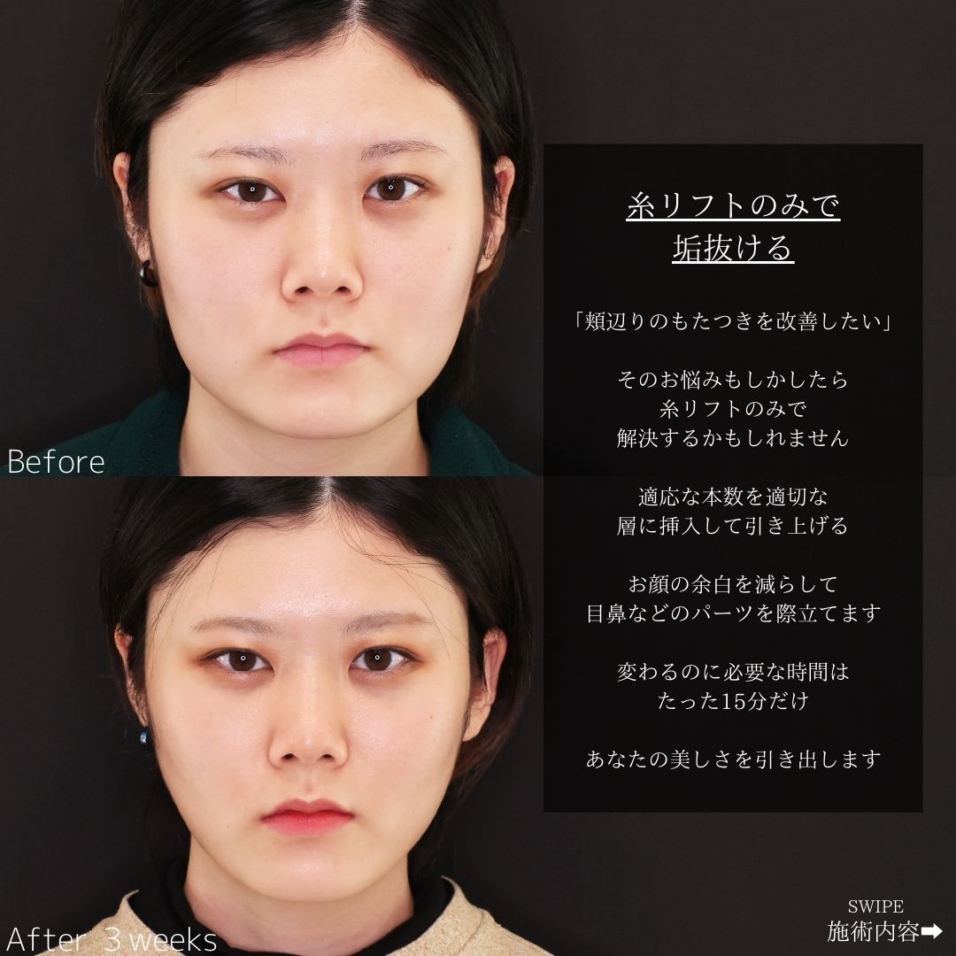 TAC式 ツヤ肌コラーゲンリフト®の症例写真 施術前後 