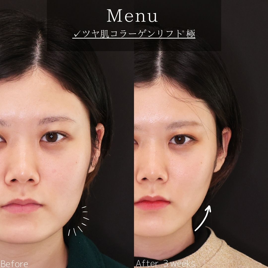 TAC式 ツヤ肌コラーゲンリフト®の症例写真 施術前後 