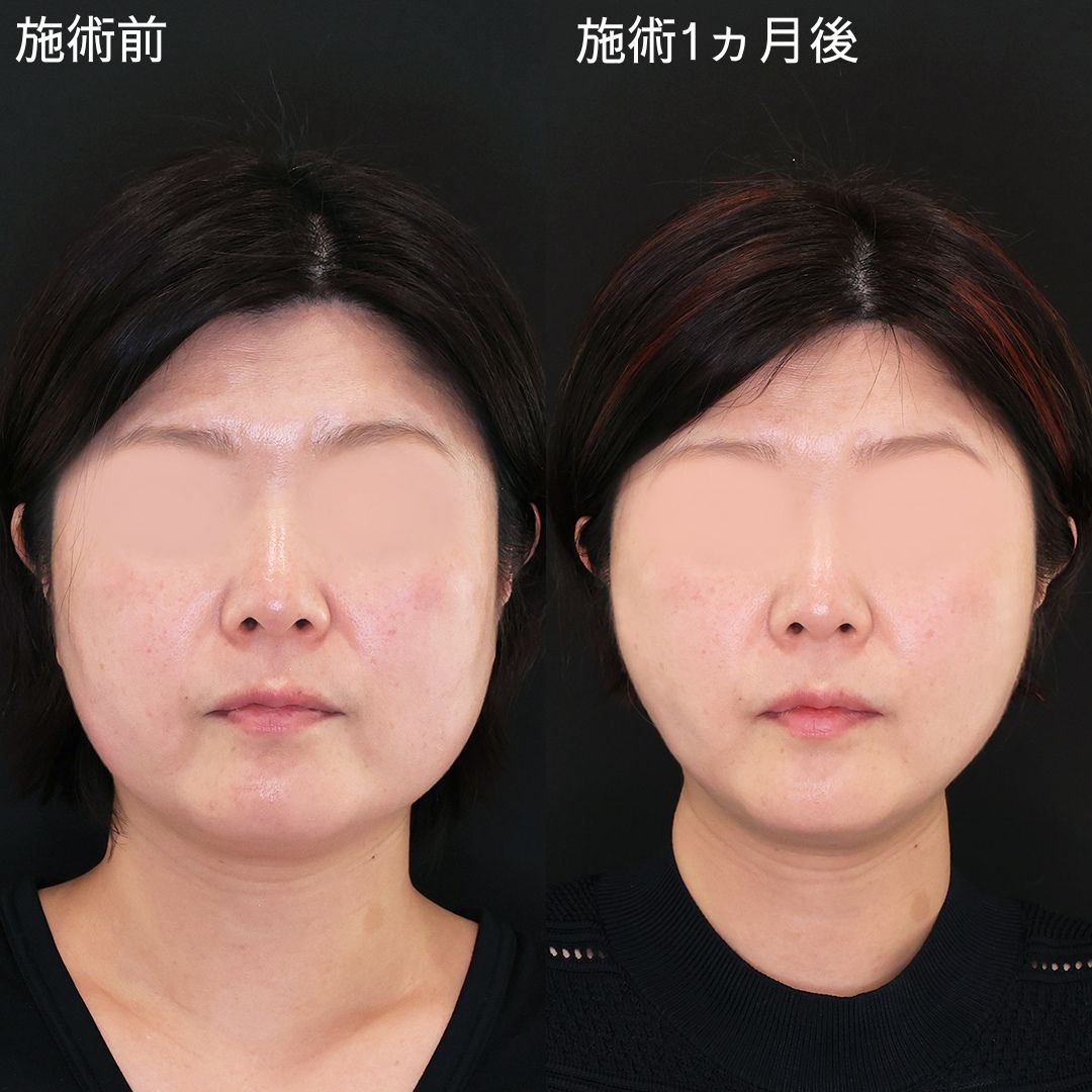 顔の余白を減らして垢抜ける！Dr.石橋の顔痩せ術【小顔複合施術】