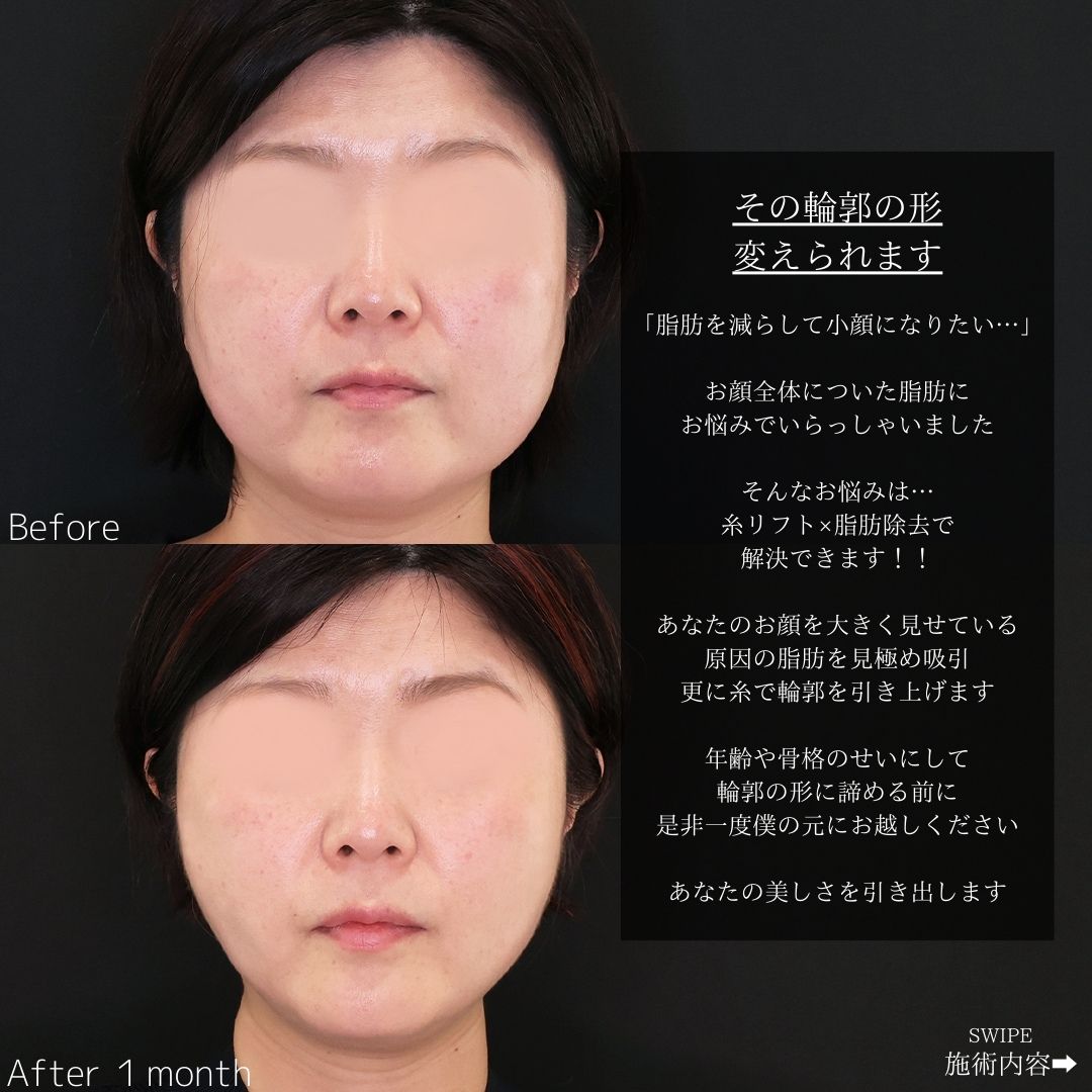 TAC式 ツヤ肌コラーゲンリフト®/ジョールファット除去/バッカルファット除去の症例写真 施術前後 