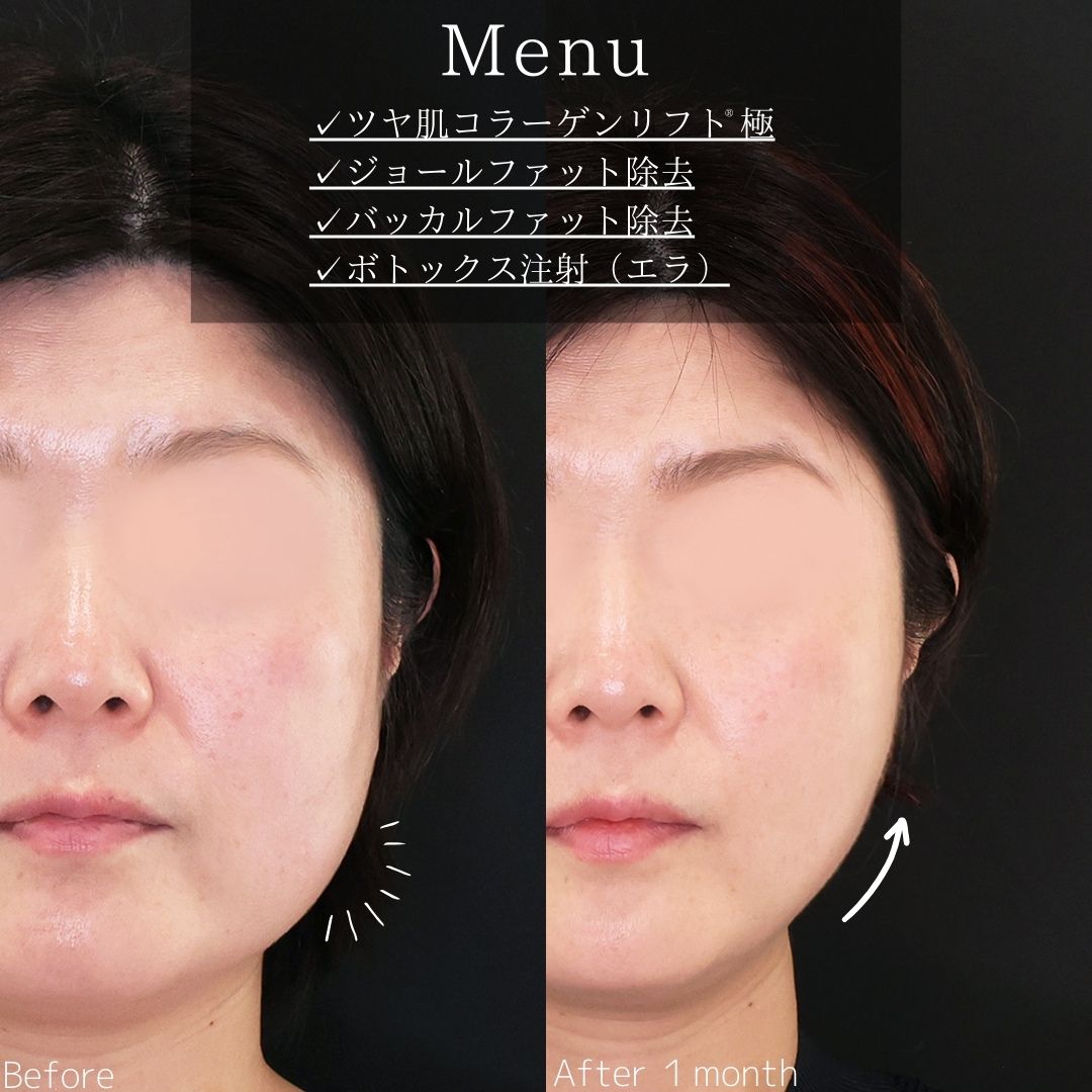 TAC式 ツヤ肌コラーゲンリフト®/ジョールファット除去/バッカルファット除去の症例写真 施術前後 
