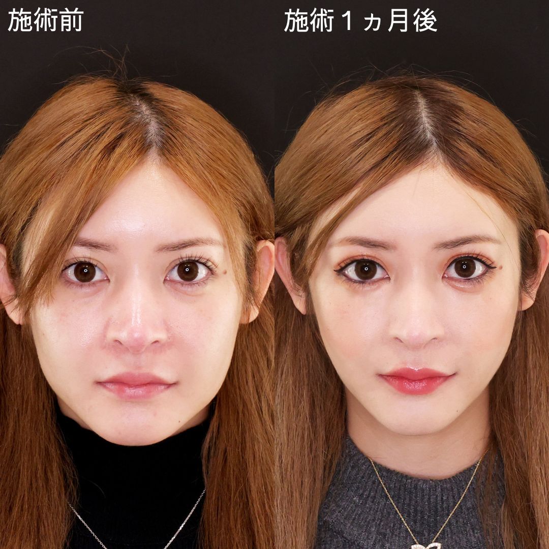 糸リフトのみで驚きのこの変化‼【糸リフト】