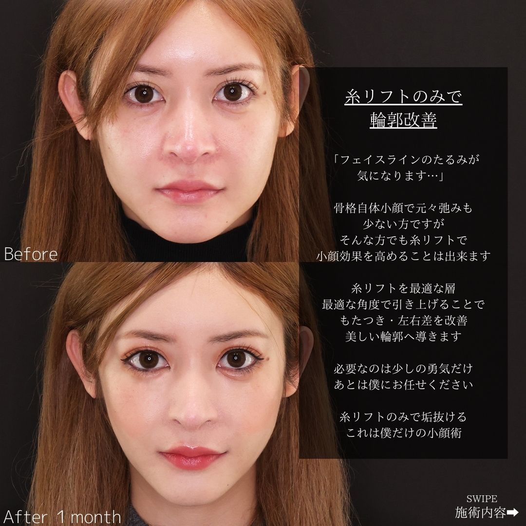 TAC式 ツヤ肌コラーゲンリフト®の症例写真 施術前後 