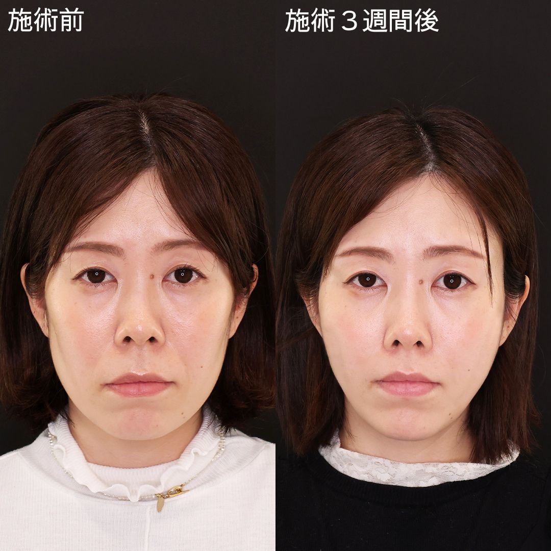 プチ整形で自然に垢抜け！Dr.石橋の小顔術【糸リフト】