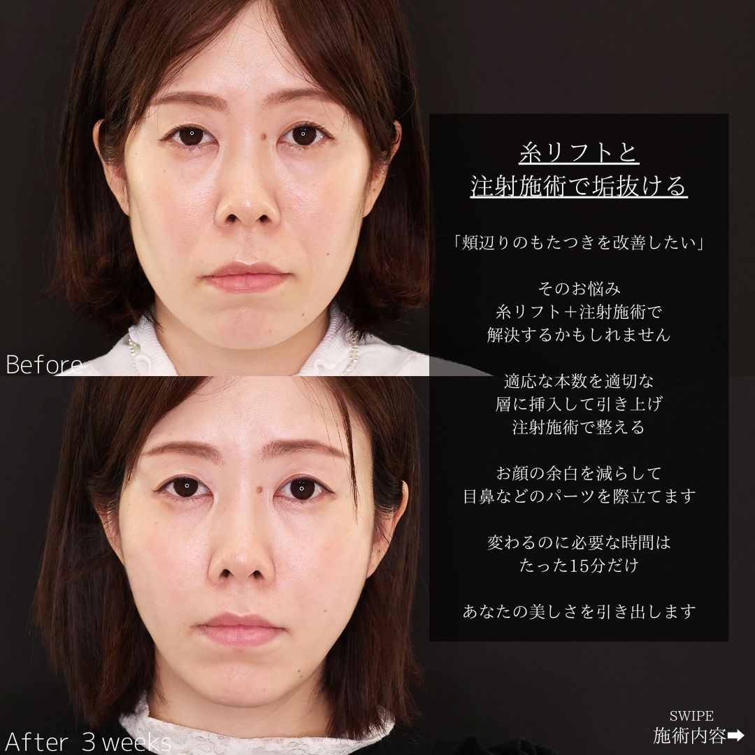 TAC式 ツヤ肌コラーゲンリフト®/ほうれい線のヒアルロン酸注射/エラボトックス注射の症例写真 施術前後 