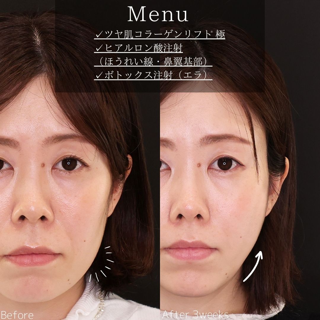 TAC式 ツヤ肌コラーゲンリフト®/ほうれい線のヒアルロン酸注射/エラボトックス注射の症例写真 施術前後 