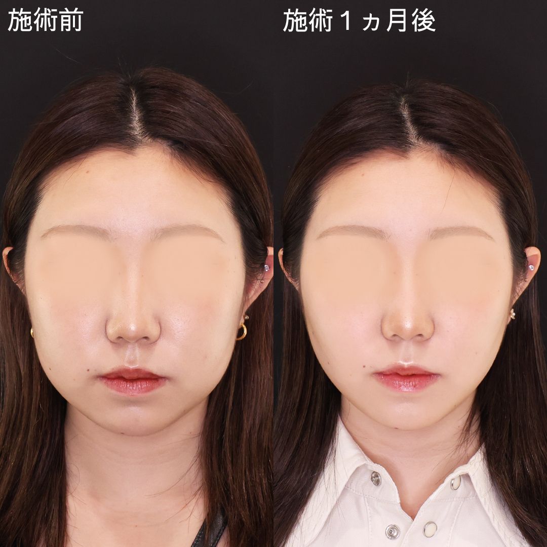 適応施術を見極め洗練！下膨れ改善リフト【糸リフト×脂肪除去】