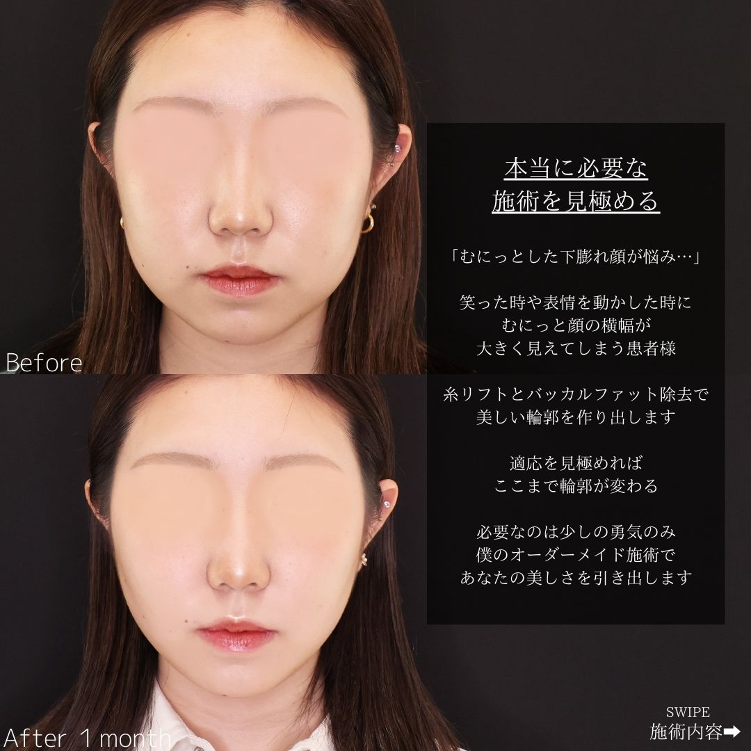 TAC式 ツヤ肌コラーゲンリフト®/バッカルファット除去/エラボトックス注射の症例写真 施術前後 