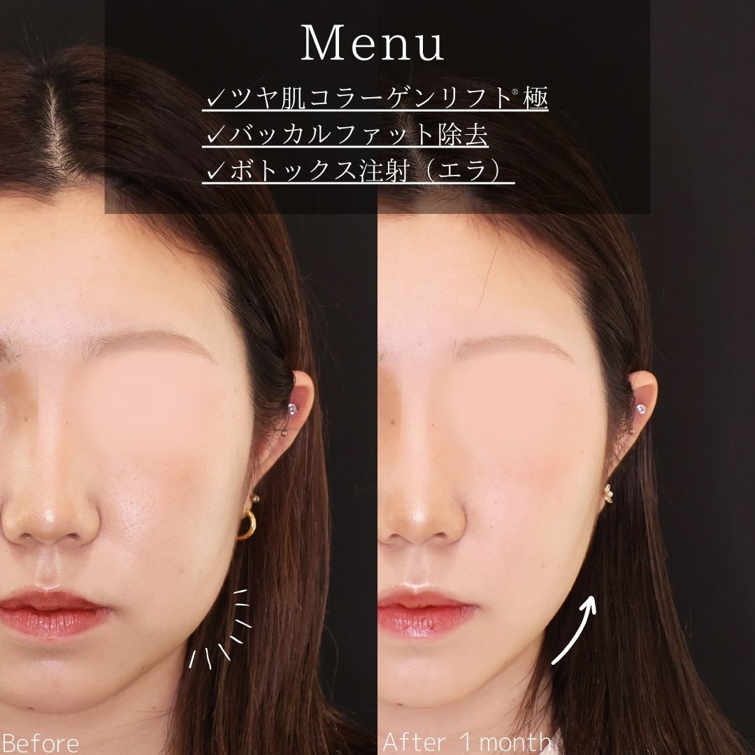 TAC式 ツヤ肌コラーゲンリフト®/バッカルファット除去/エラボトックス注射の症例写真 施術前後 