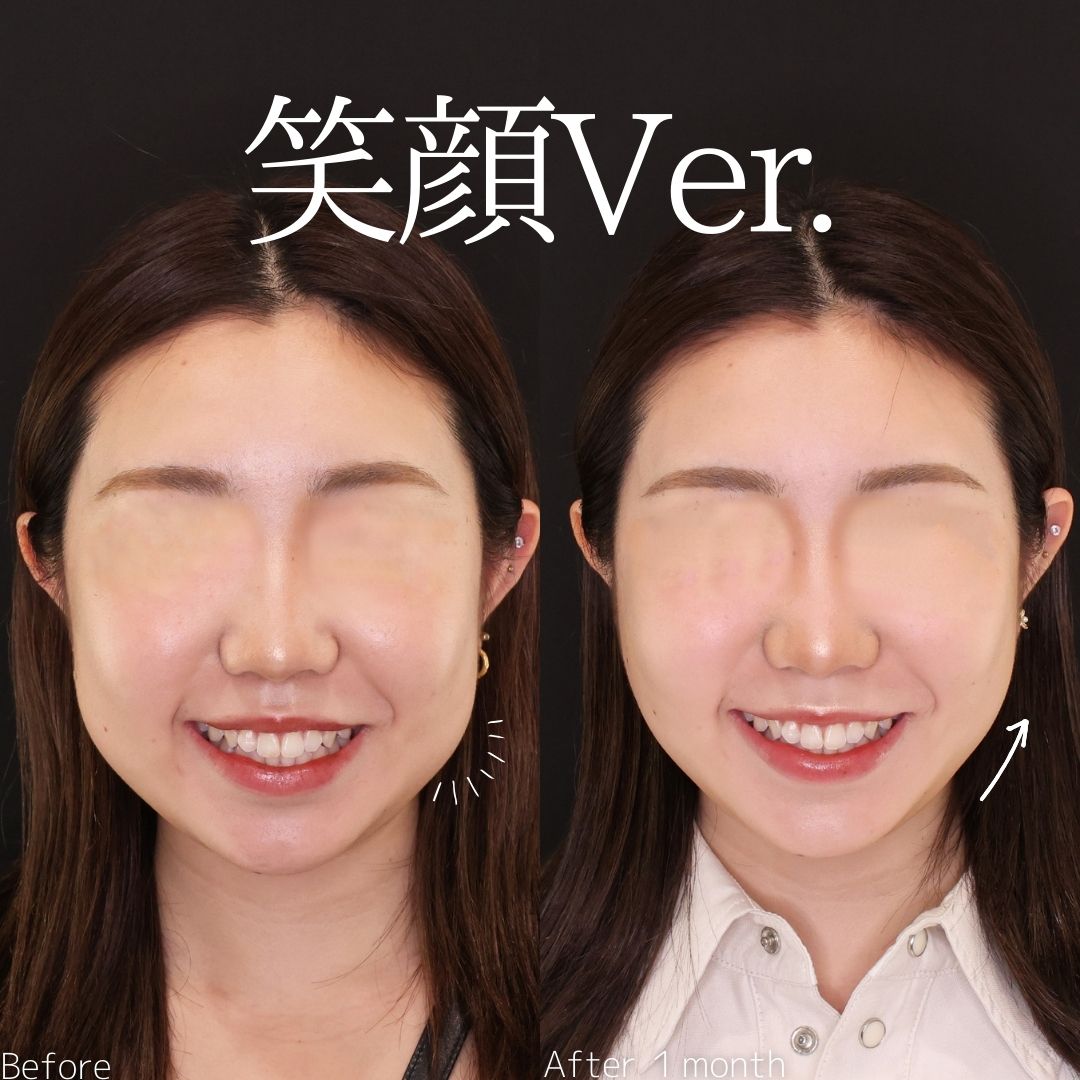 TAC式 ツヤ肌コラーゲンリフト®/バッカルファット除去/エラボトックス注射の症例写真 施術前後 