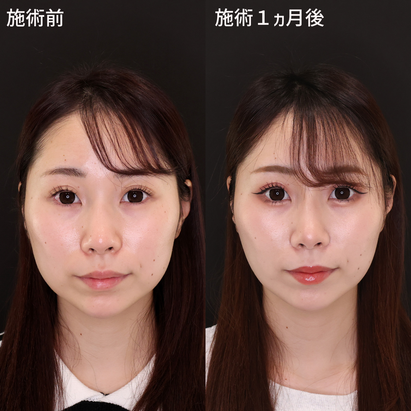 TAC式 ツヤ肌コラーゲンリフト®の症例写真 施術前後