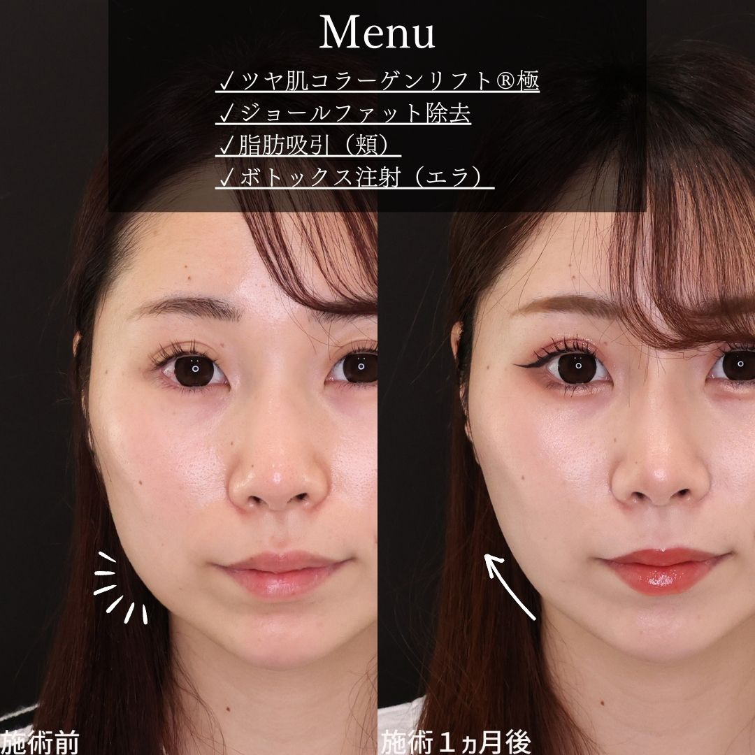 TAC式 ツヤ肌コラーゲンリフト®の症例写真 施術前後