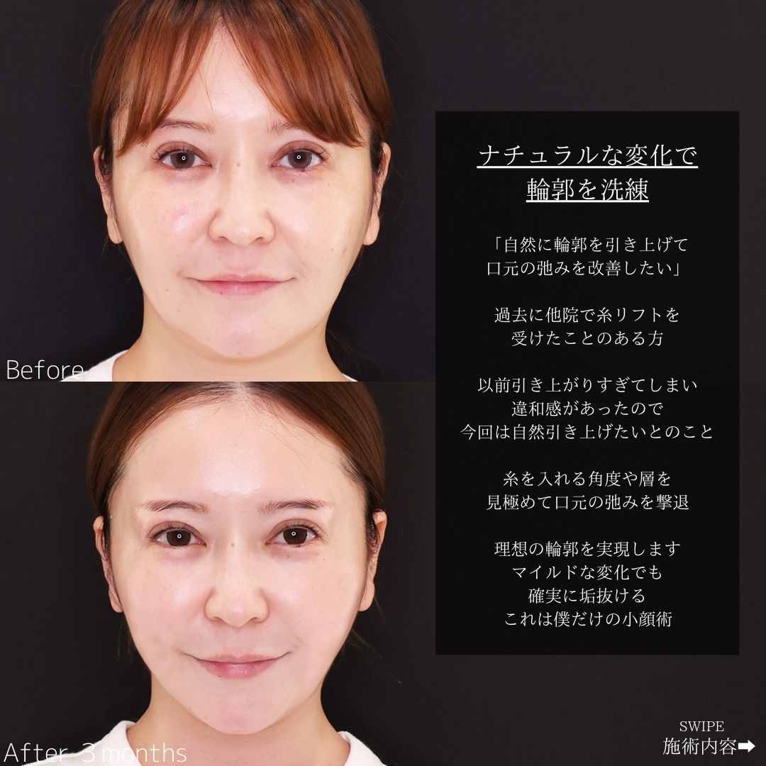 TAC式 ツヤ肌コラーゲンリフト®/ジョールファット除去/TAC式 ショッピングリフトの症例写真 施術前後 