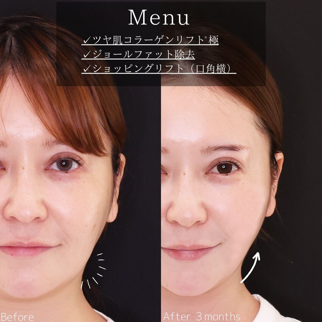TAC式 ツヤ肌コラーゲンリフト®/ジョールファット除去/TAC式 ショッピングリフトの症例写真 施術前後 