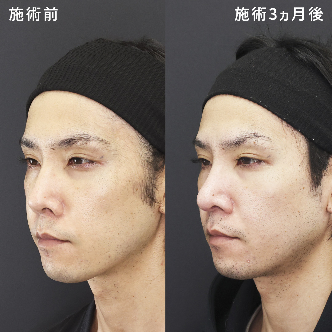 【男性の鼻整形】短鼻を改善し整える