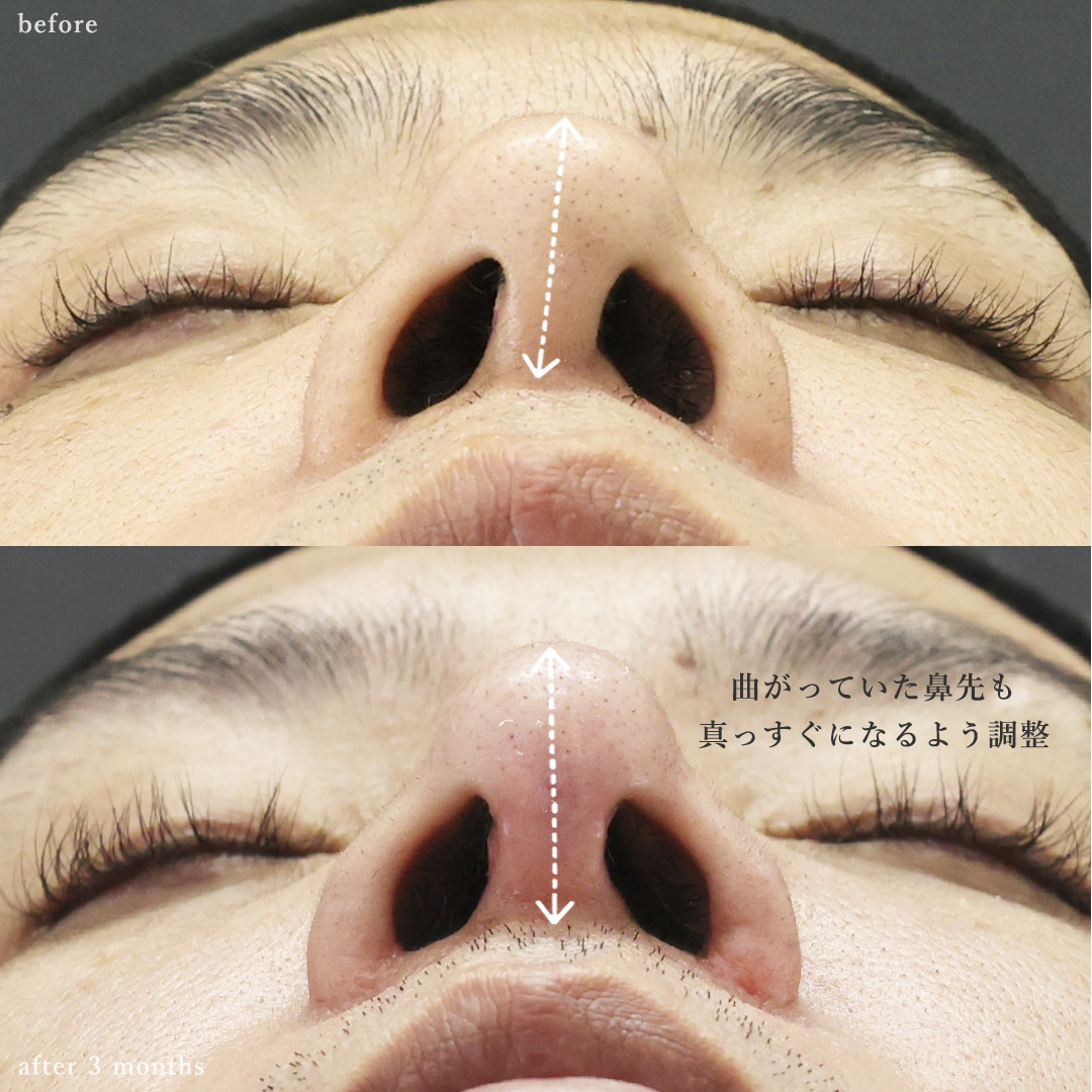 鼻尖形成・鼻尖縮小/鼻孔縁挙上術の症例写真 施術前後
