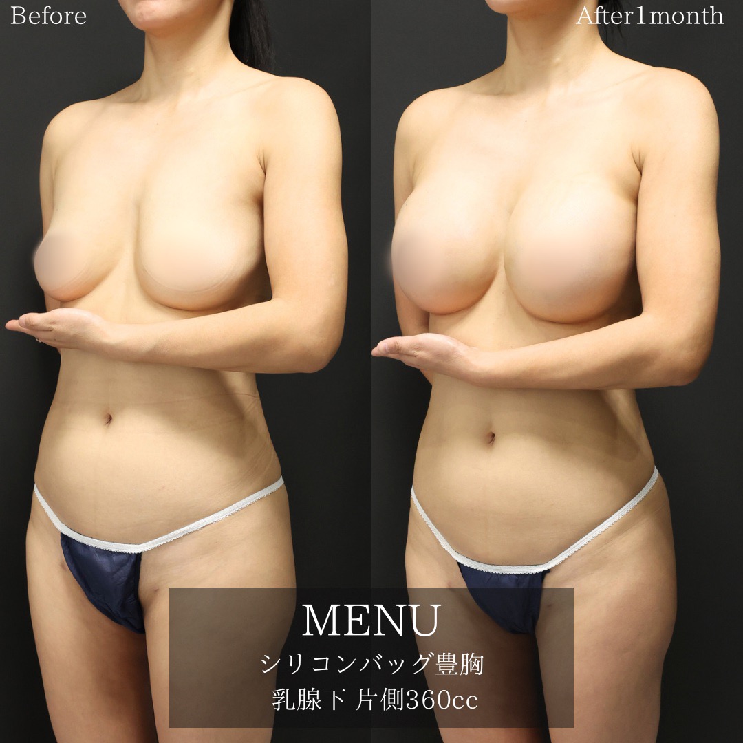 シリコンバッグ豊胸（人工乳腺バッグ）の症例写真 施術前後 
