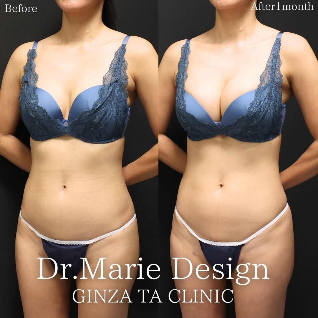 シリコンバッグ豊胸（人工乳腺バッグ）の症例写真 施術前後 