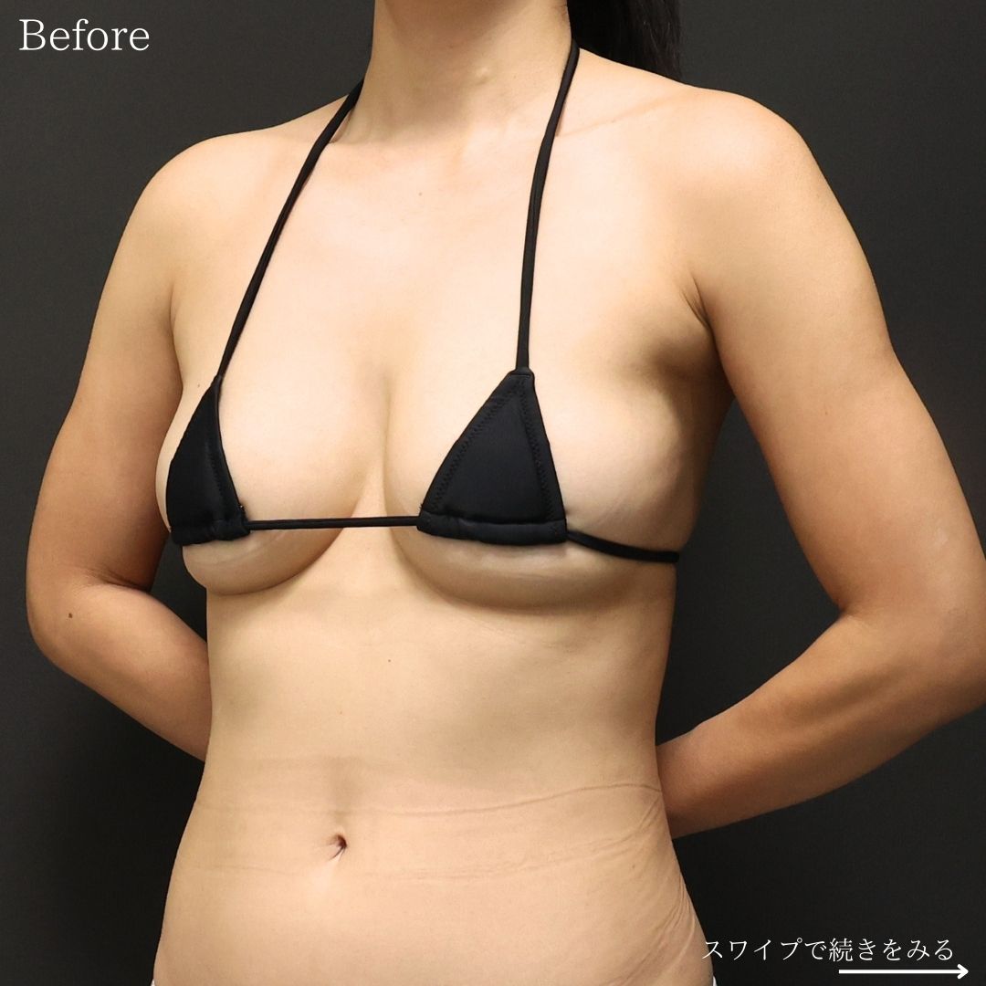 シリコンバッグ豊胸（人工乳腺バッグ）の症例写真 施術前後 