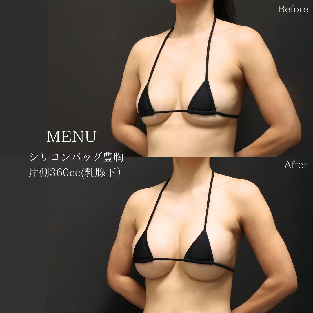 シリコンバッグ豊胸（人工乳腺バッグ）の症例写真 施術前後 
