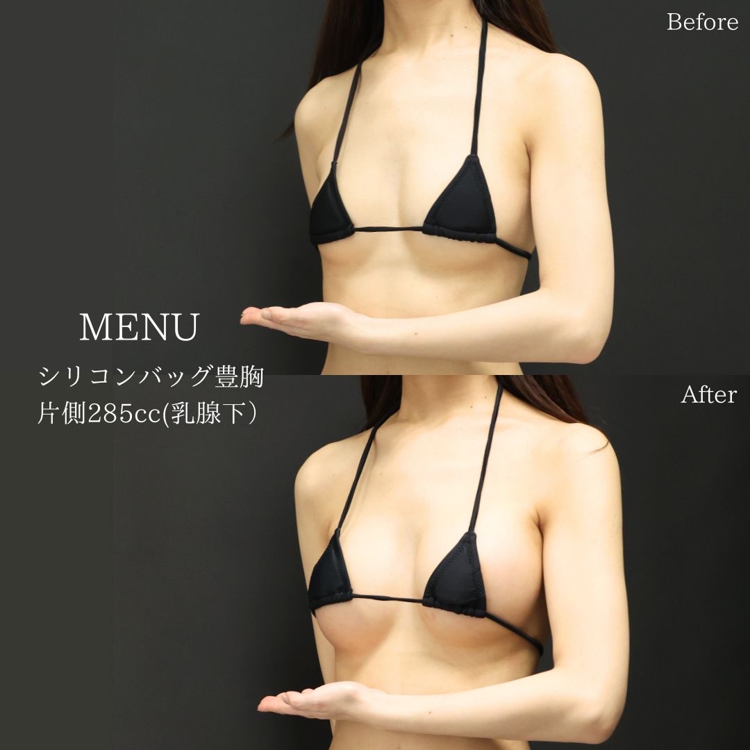 シリコンバッグ豊胸（人工乳腺バッグ）の症例写真 施術前後 