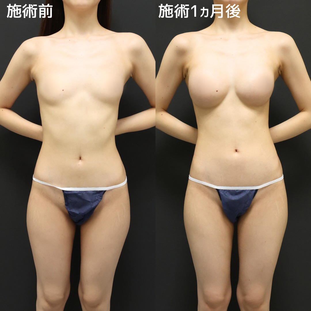《シリコンバック豊胸》長年の悩み解消でオシャレも楽しく♪