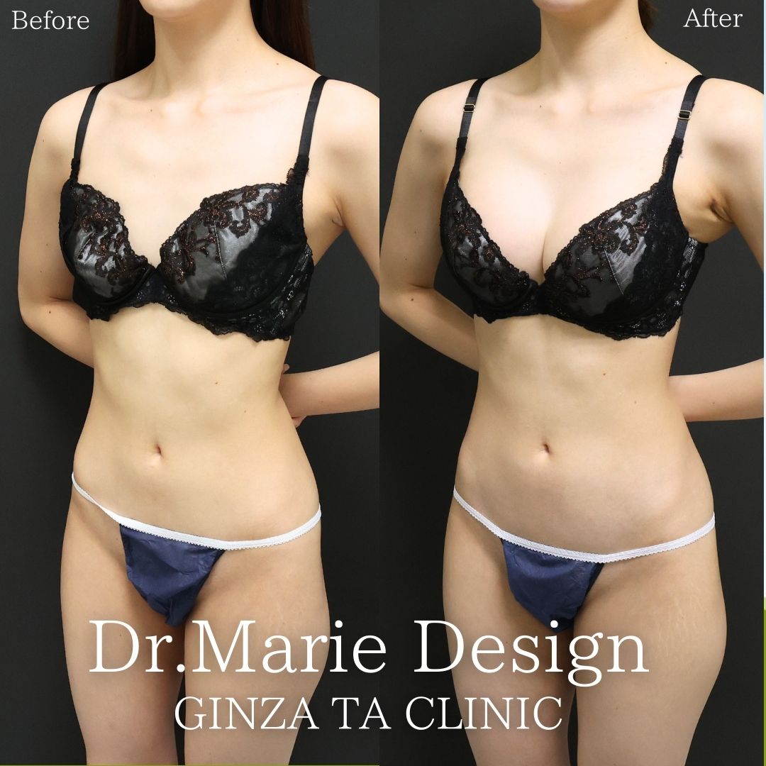 シリコンバッグ豊胸(人工乳腺バッグ)の症例写真 施術前後