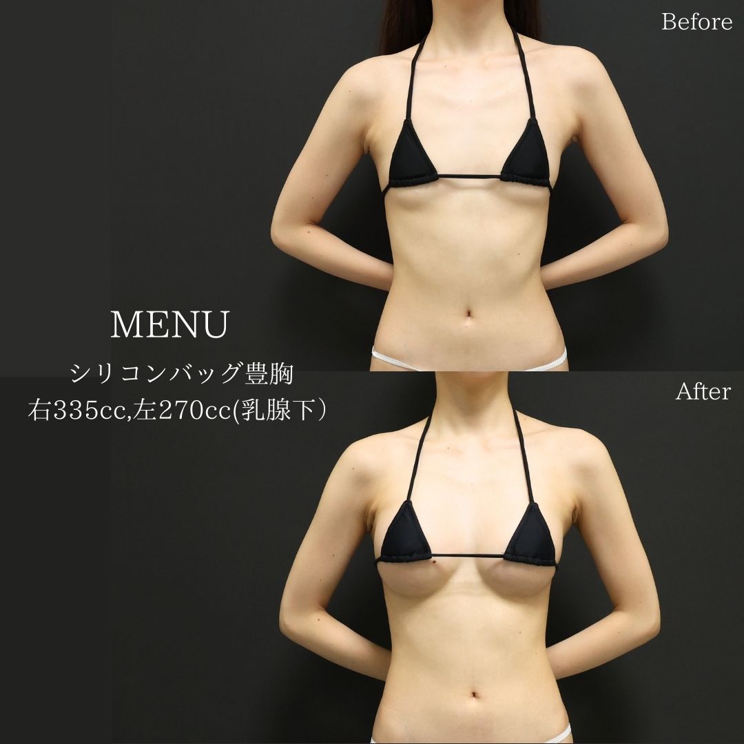 シリコンバッグ豊胸(人工乳腺バッグ)の症例写真 施術前後