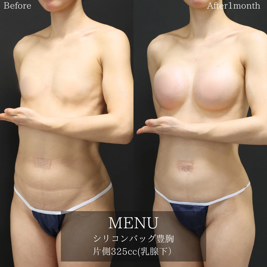 シリコンバッグ豊胸(人工乳腺バッグ)の症例写真 施術前後