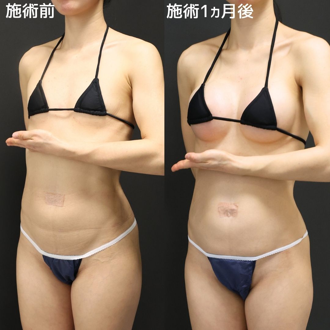 シリコンバッグ豊胸（人工乳腺バッグ）の症例写真 施術前後 