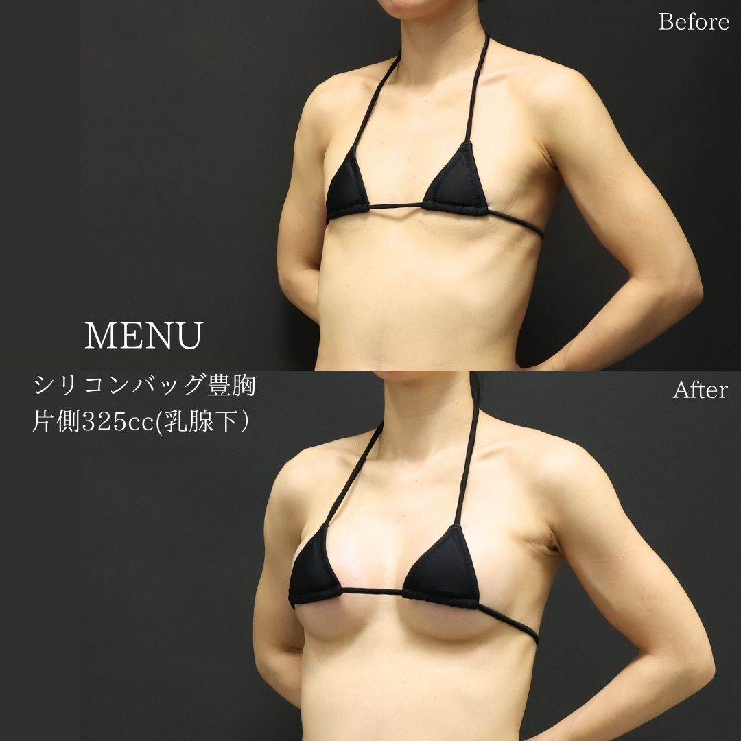 シリコンバッグ豊胸（人工乳腺バッグ）の症例写真 施術前後 