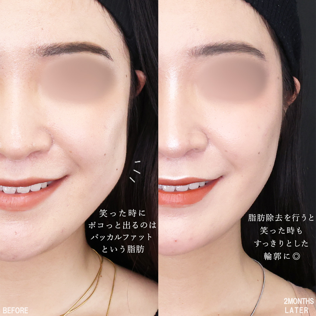 TAC式 ツヤ肌コラーゲンリフト®/バッカルファット除去/エラボトックス注射の症例写真 施術前後