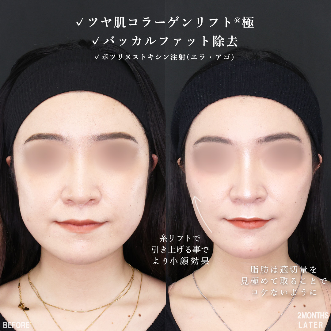 TAC式 ツヤ肌コラーゲンリフト®/バッカルファット除去/エラボトックス注射の症例写真 施術前後