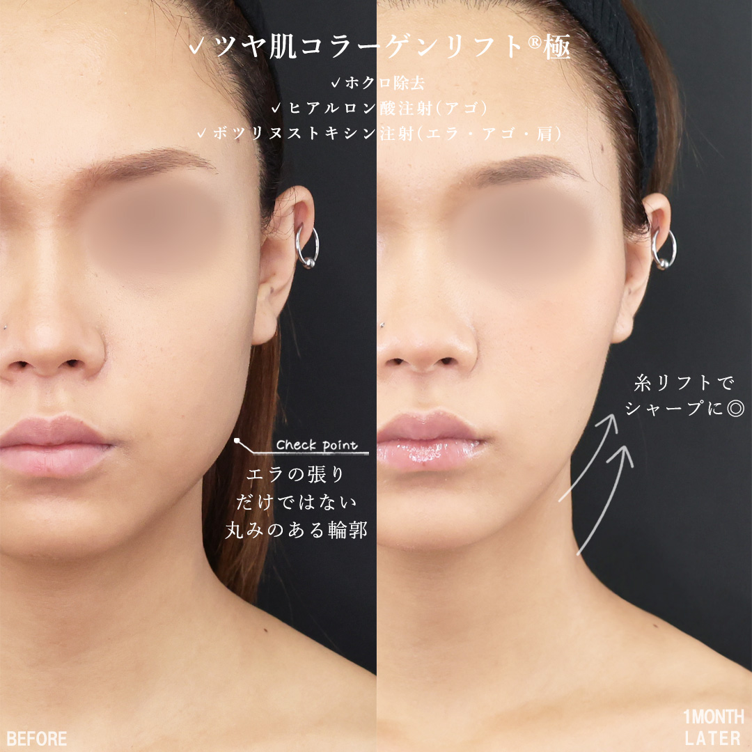 TAC式 ツヤ肌コラーゲンリフト®/顎のヒアルロン酸注射/エラボトックス注射の症例写真 施術前後